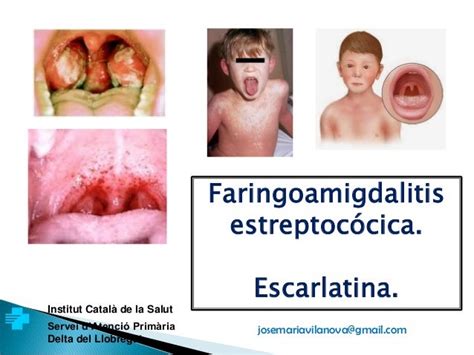 beta strep|Amigdalitis estreptocócica .